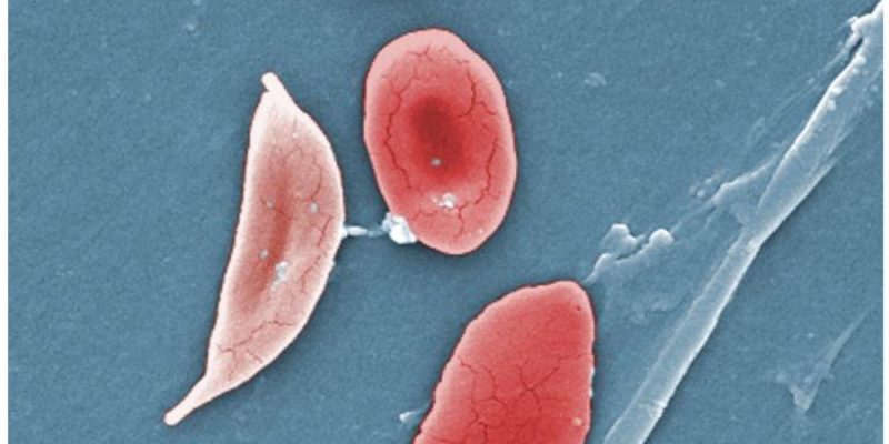 Eine revolutionäre Gentherapie könnte Patienten mit chronischer Sichelzellenanämie neues Leben ermöglichen