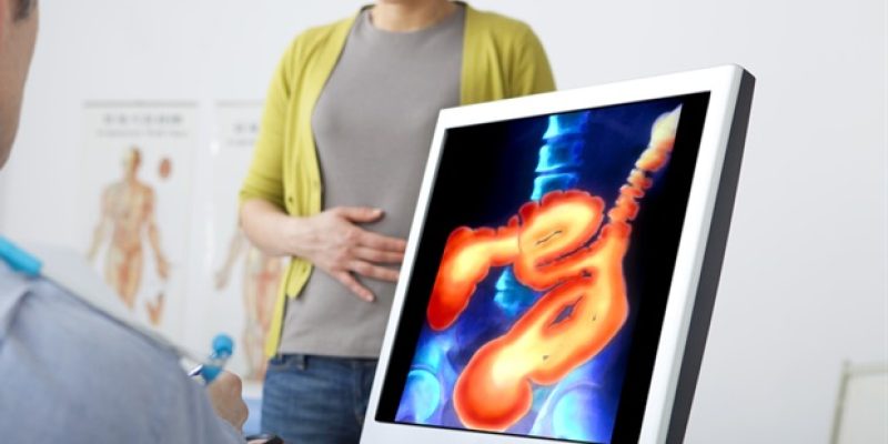 Das Mount Sinai-Projekt erhält einen Zuschuss von 4 Millionen US-Dollar, um die frühen Stadien von Morbus Crohn zu verstehen