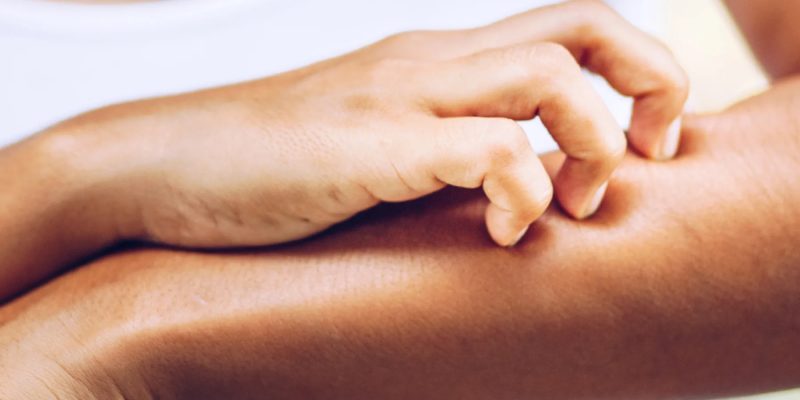 Herausforderungen schwerer atopischer Dermatitis – und wie es weitergeht