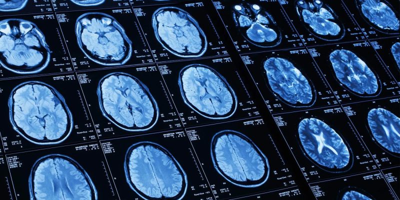 Schlaganfallrisiko bei schwarzen Amerikanern: Fragen und Antworten von Experten