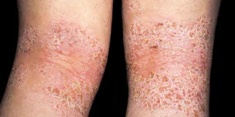 Handelt es sich um trockene Haut oder Neurodermitis?