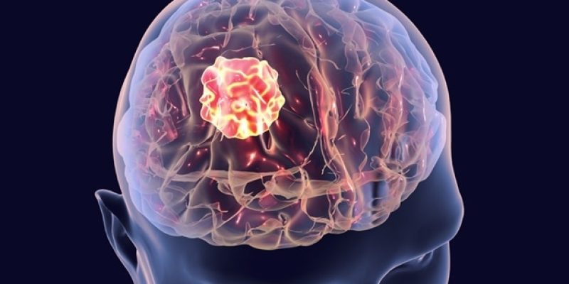 Der Konsum von Glitazon-Medikamenten bei Diabetikern ist mit einem geringeren Risiko für primären und sekundären Hirntumor verbunden