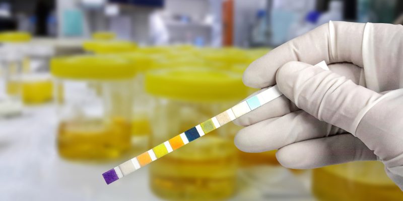 Im Frühstadium der Pandemie sinken die Diagnosen von Harnwegsinfekten bei Kindern, der Schweregrad bleibt unverändert