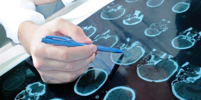 Migränesymptome im Zusammenhang mit Veränderungen des Netzhautblutflusses