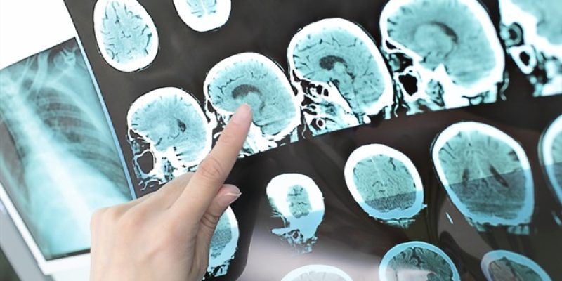 Die meisten Schlaganfallüberlebenden können zwei Arten gängiger Antidepressiva sicher einnehmen