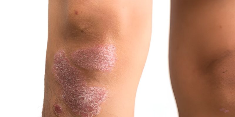 Studien zu biologischen Wirkstoffen gegen Psoriasis umfassen selten Patientenbilder