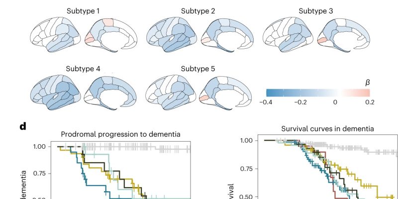 Unterschiede in der Gehirn-Rückenmarks-Flüssigkeit von Alzheimer-Patienten lassen auf die Möglichkeit von Varianten schließen