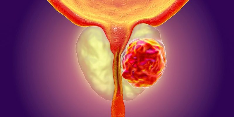 Höher dosierte RT verlängert das Überleben bei Hochrisiko-Prostatakrebs