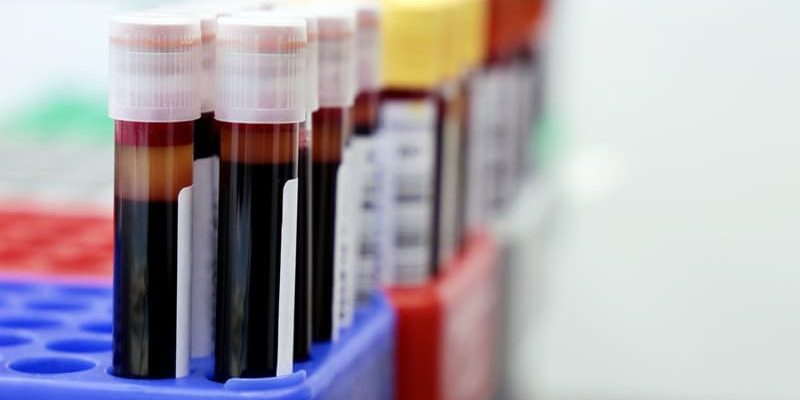 Studie zeigt Unterschiede bei den Trends bei CRC-Biomarker-Tests