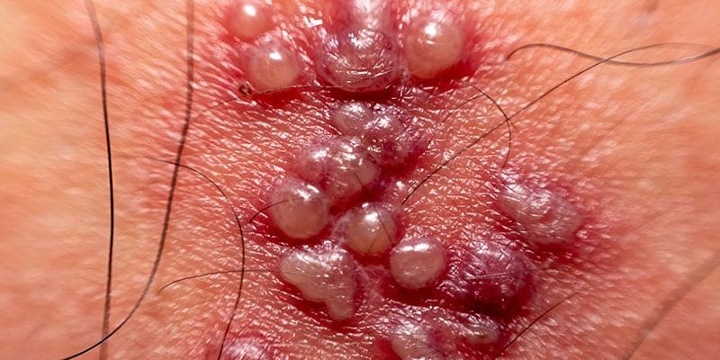 Der Impfstoff gegen Gürtelrose bietet 4 Jahre Schutz