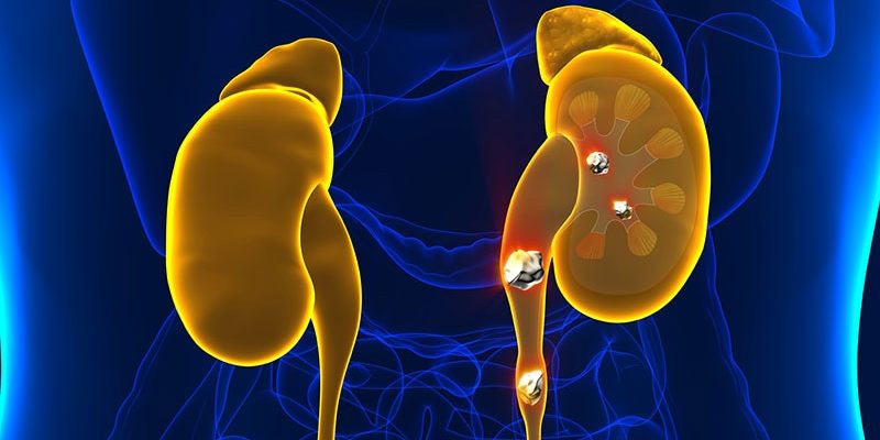 Kann ein gesundes Darmmikrobiom Nierensteine verhindern?