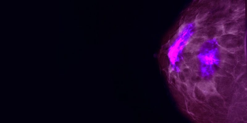 Neue Studien bei Brustkrebs: Könnte Ihre Patientin davon profitieren?