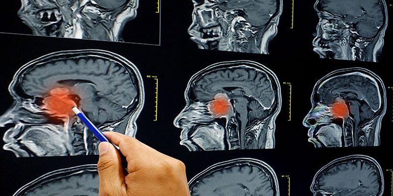 Extrakranielle Chirurgie kurz nach Schädel-Hirn-Trauma führte zu schlechteren Ergebnissen