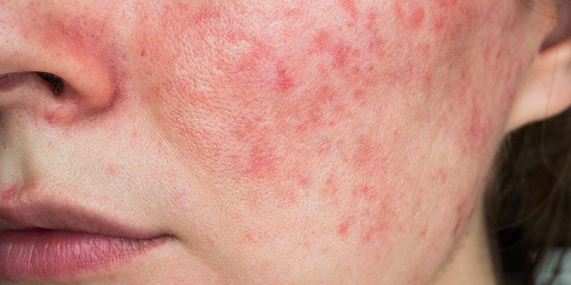 Studie legt nahe, dass die Auswirkungen einer Schwangerschaft auf Rosacea unvorhersehbar sind
