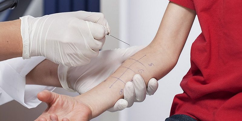 Wie sollten Dermatologen bei Verdacht auf Arzneimittelallergien vorgehen?