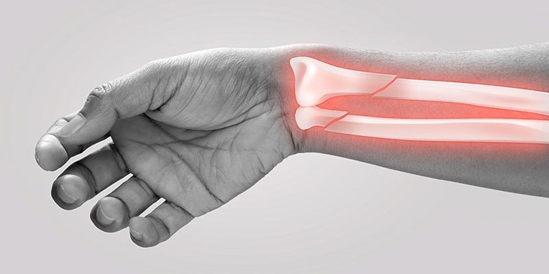 Testosteron erhöht das Frakturrisiko bei hypogonadalen Männern?