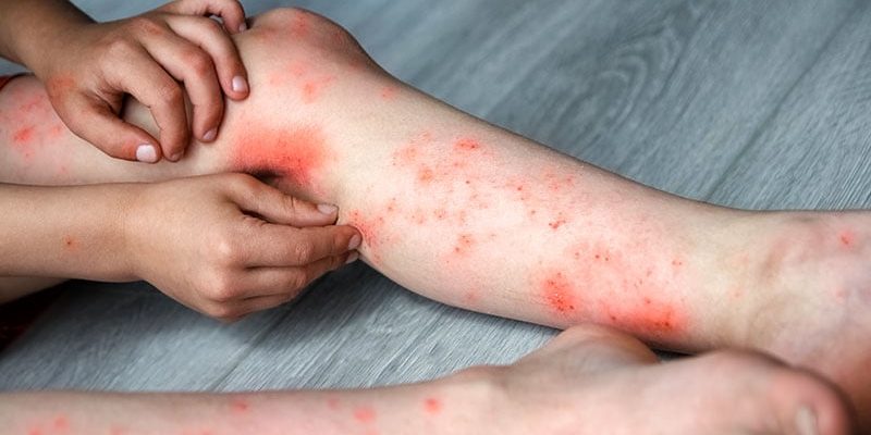 Studie bescheinigt multidisziplinäre pädiatrische AD-Klinik Vorteile