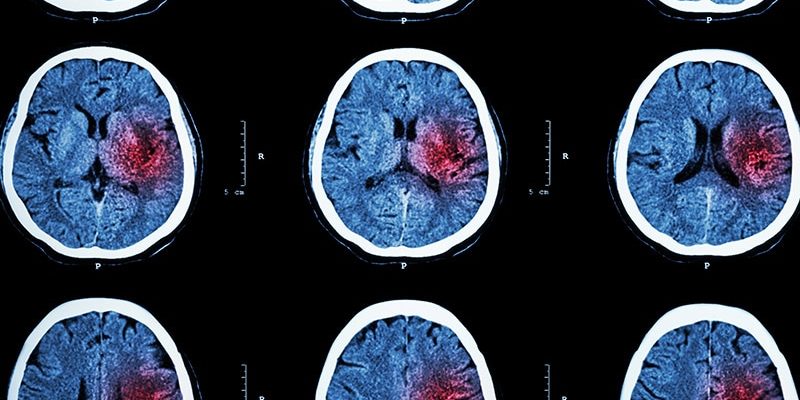Gemischte Ergebnisse für niedrig dosierte Steroide mit Thrombektomie