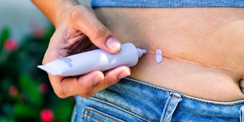 Analyse findet Allergene in vielen topischen Narbenprodukten