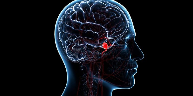 Neue Schlaganfallprävention: Clopidogrel-Aspirin innerhalb von 72 Stunden