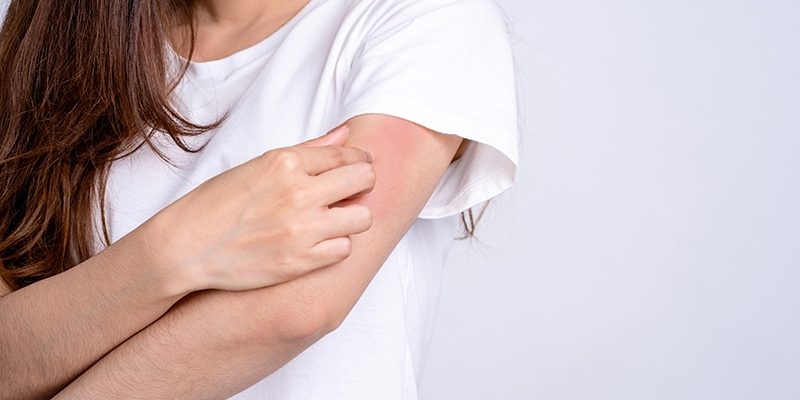 Denken Sie bei der Behandlung von Juckreiz über den Tellerrand der herkömmlichen Methoden hinaus