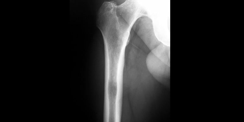 SBRT sicher, effektiv für Patienten mit nicht-wirbelsäulenförmigen Knochenmetastasen