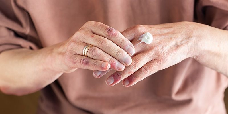 Experte hebt Biologika in der Pipeline für Ekzeme hervor