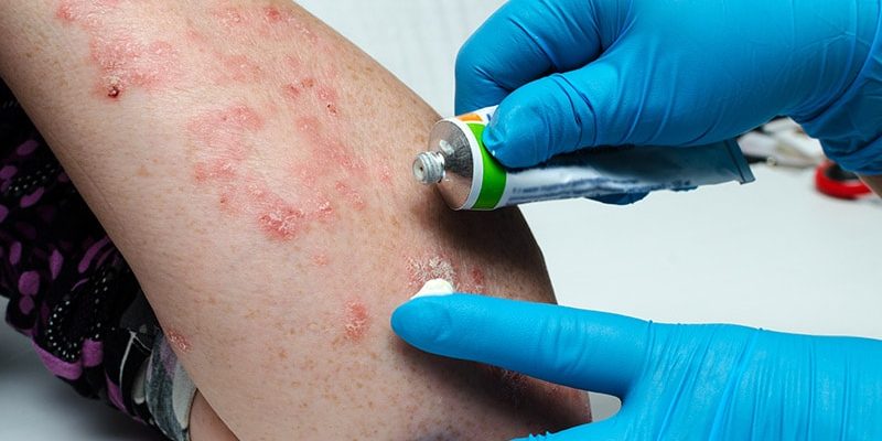 Studie identifiziert kardiovaskuläre Komorbiditäten im Zusammenhang mit Dermatomyositis