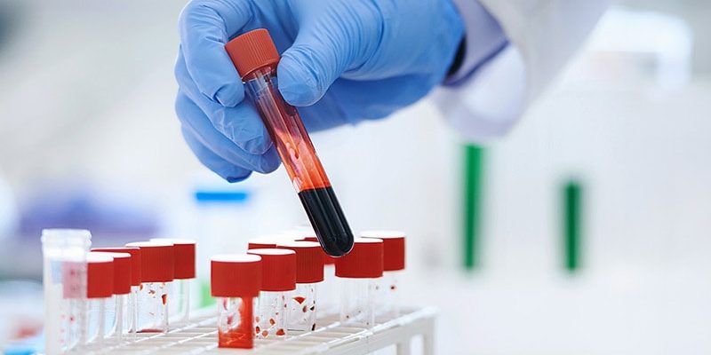 Biomarkertests optimieren die Therapieauswahl bei fortgeschrittenem NSCLC