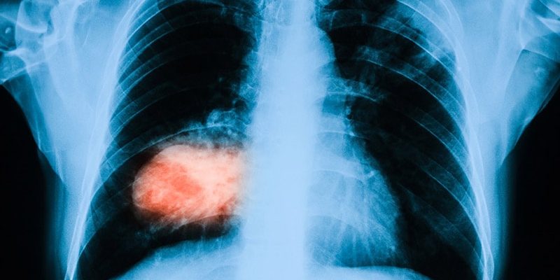 Wie ein einfacher Urintest Lungenkrebs im Frühstadium aufdecken könnte