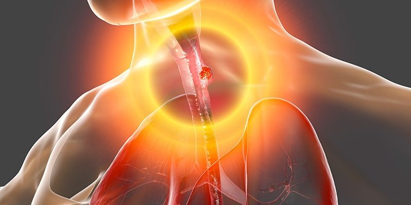 Die Argumente für Biomarker-Tests bei gastroösophagealem Krebs