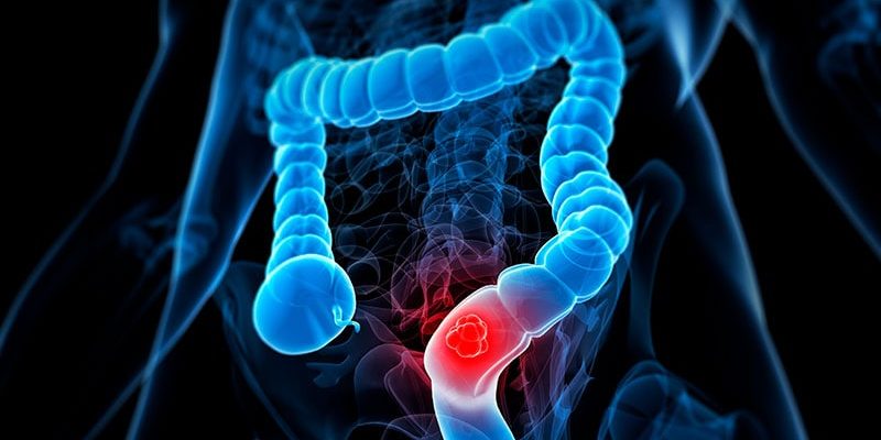 Schlüsselfaktoren der Team-IDs für den synthetischen Querlenker im Mets CRC