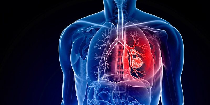 Toxizität im Zusammenhang mit längerem Überleben bei Patienten mit NSCLC