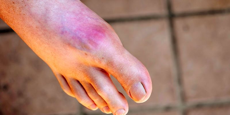 Zielen Sie auf diese Serumharnsäurespiegel, um Gichtanfälle zu verhindern