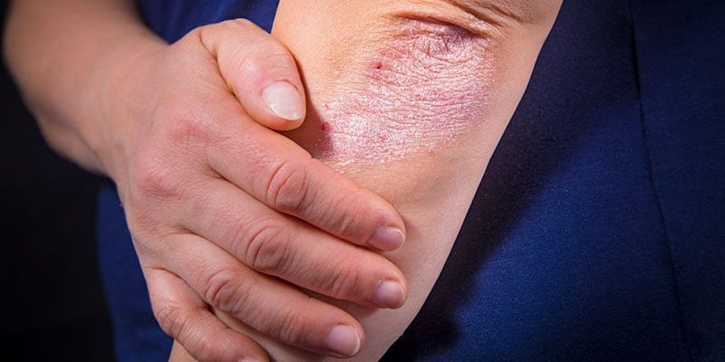 Oraler IL-23-Inhibitor lindert mittelschwere bis schwere Psoriasis