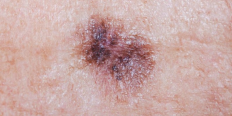 Wie hoch ist die Inzidenzrate eines zweiten primären Melanoms?