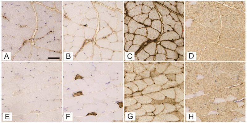 Wie verändert Typ-1-Diabetes die Muskelstruktur und die Blutversorgung?