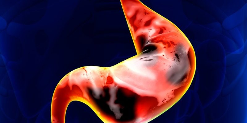 Das Überleben bei Magenkrebs unterscheidet sich je nach Rasse und ethnischer Zugehörigkeit