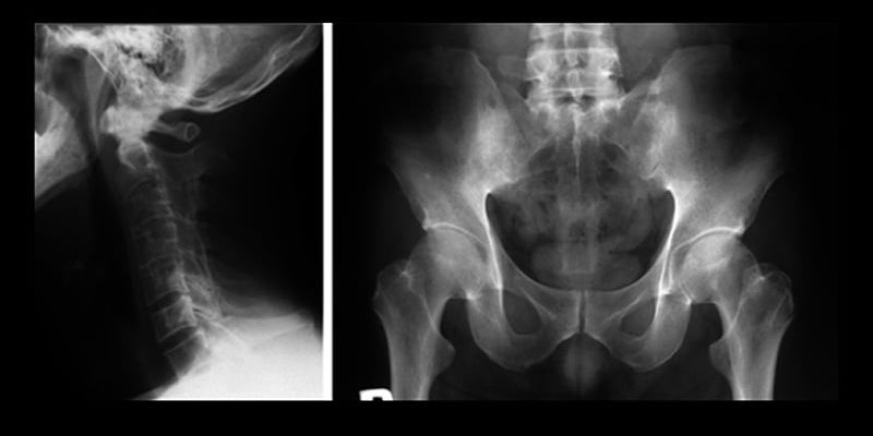 Übergang zur Radiographic SpA: Risikofaktoren und Zeitrahmen