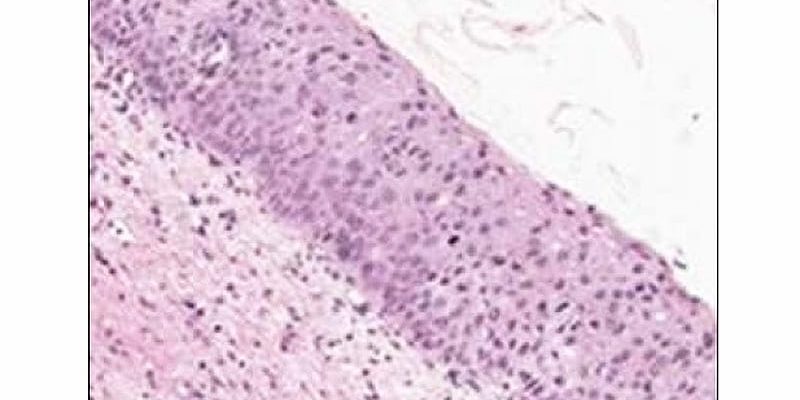 HPV-Vax verringert die Wahrscheinlichkeit einer Progression zervikaler Läsionen