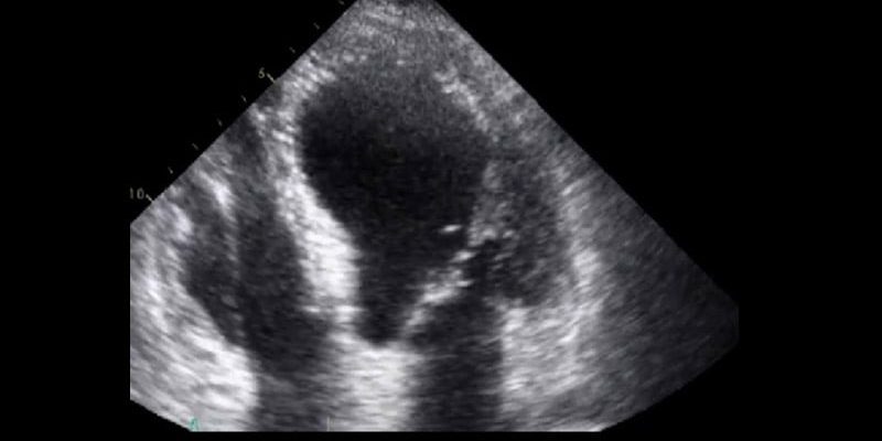 Neue Erkenntnisse zur Mortalität beim Takotsubo-Syndrom