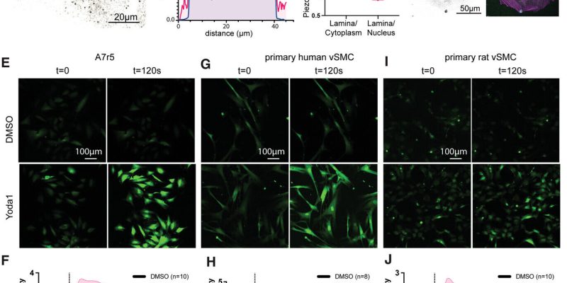 Druckbedingte Schaumzellenbildung erwies sich als Hauptursache für Arterienerkrankungen und ebnete den Weg für neue Therapien