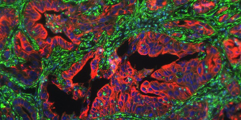 Forscher identifizieren Protein, das mit der Metastasierung bei Bauchspeicheldrüsenkrebs in Zusammenhang steht