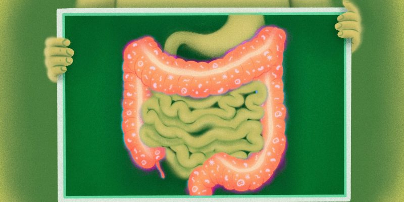 Forscher ermitteln, warum eine Krebsimmuntherapie Kolitis verursachen kann