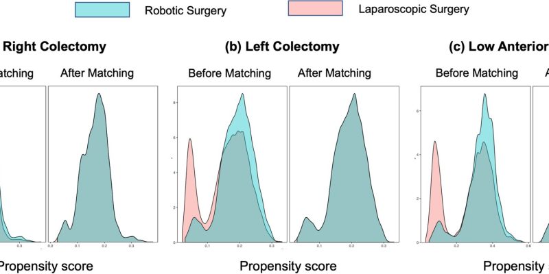 Laut einer Studie verbessert die Roboterchirurgie die Ergebnisse für die meisten Darmkrebspatienten