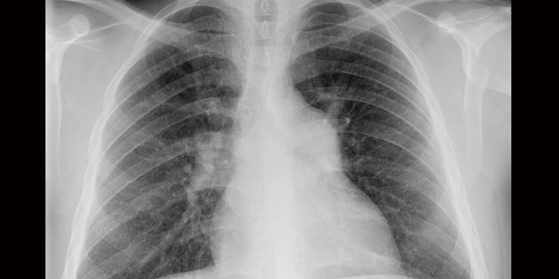 Trotz Fortschritten ist die Sterblichkeit bei Hochrisiko-PE immer noch signifikant