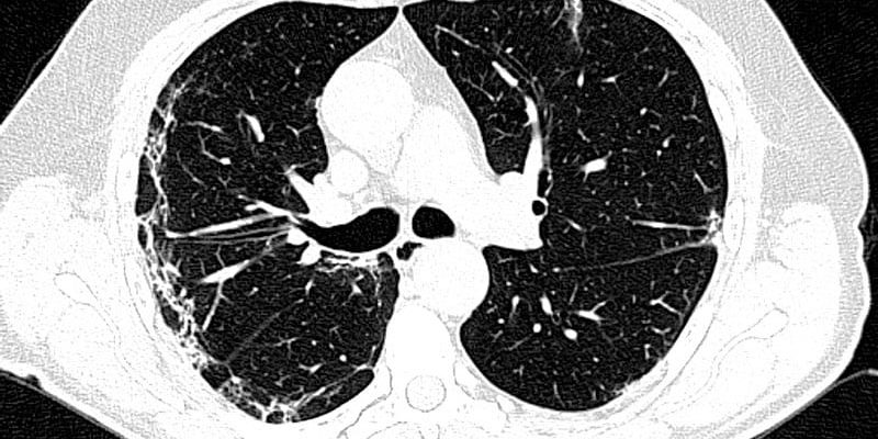 Diagnose von COVID-19 vs. RSV, Grippe