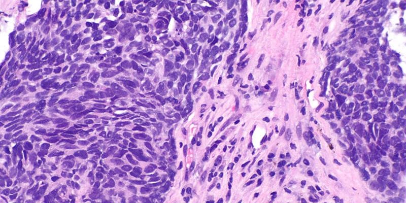 Der adaptive SABR-Boost ist bei fortgeschrittenem NSCLC vielversprechend